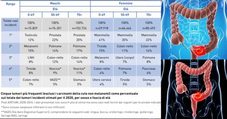 Screening tumore del colon-retto: 2° nelle donne, 3° negli uomini