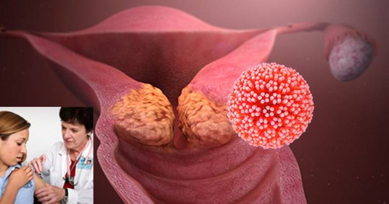 Vaccinazioni HPV: la fortuna di nascere in Italia e non in Romania