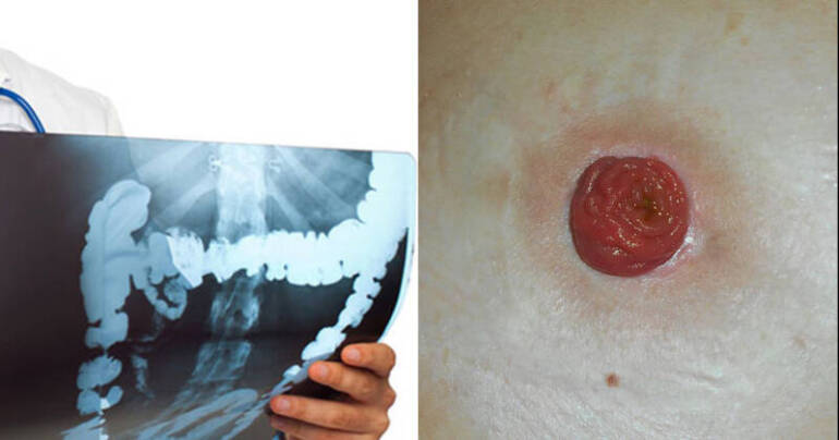 Ambulatorio di proctologia attivato al San Leonardo di Castellammare Stabia