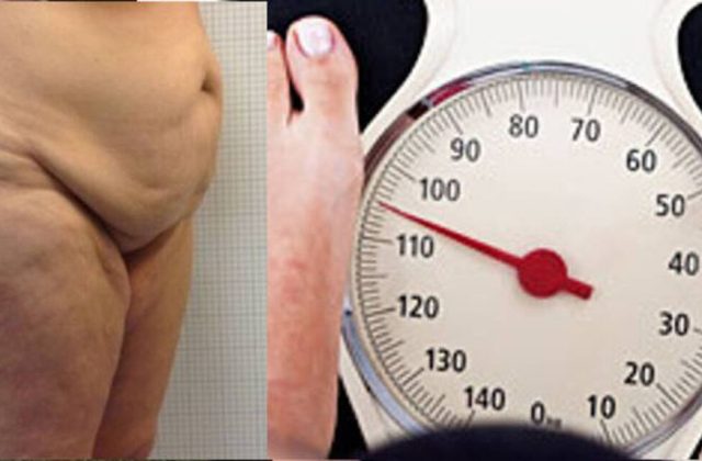 Obesità: tra Interventi sullo stomaco e Chirurgia estetica addominale