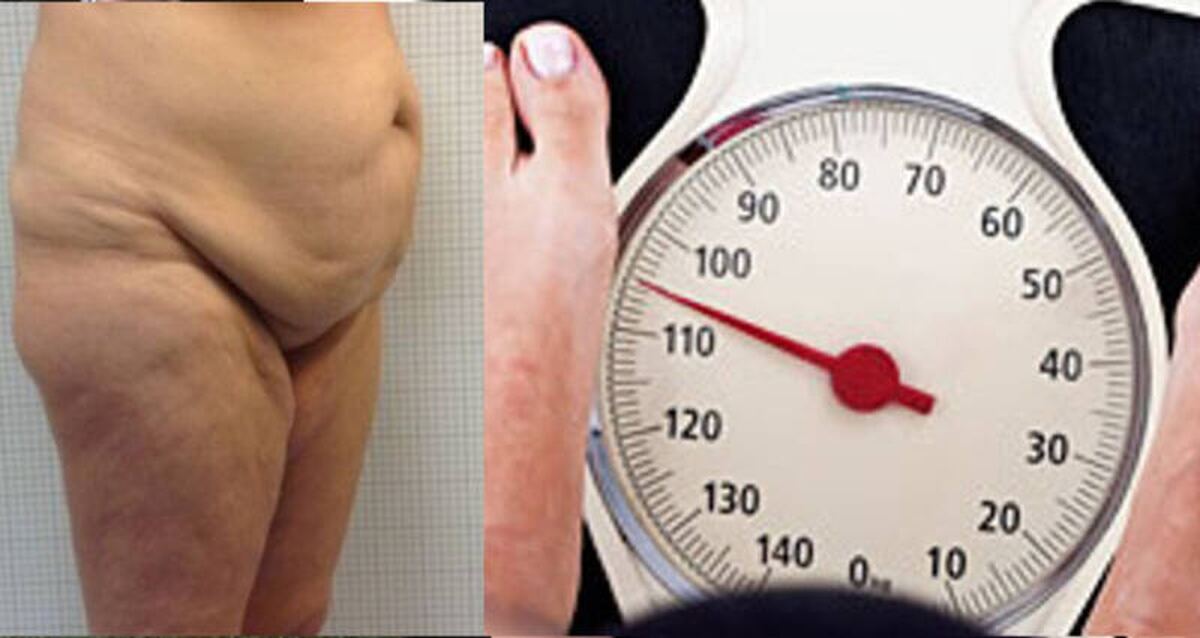 Obesità: tra Interventi sullo stomaco e Chirurgia estetica addominale
