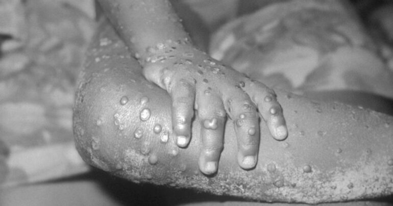 Monkeypox o vaiolo delle scimmie dopo il Covid e la Guerra in Ucraina