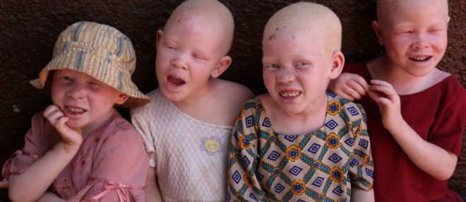 Giornata Internazionale dell'Albinismo