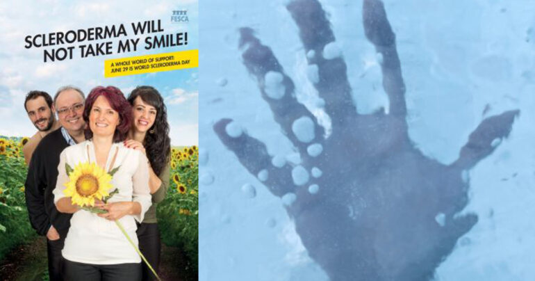 Giornata Mondiale della Sclerosi Sistemica: 29 giugno