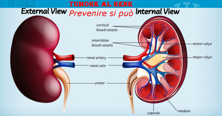 Tumore al rene: 16 giugno Giornata Mondiale, una giornata per approfondire