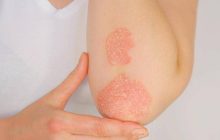 Giornata psoriasi, Ucb rinnova l’impegno contro lo stigma