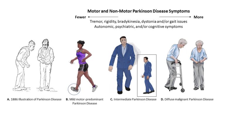 Il Morbo di Parkinson: Note e Consigli per Convivere al Meglio