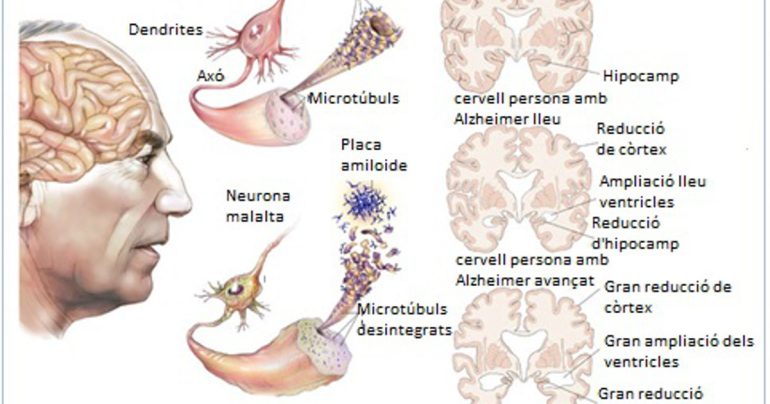Come vivere e convivere con l’Alzheimer: consigli pratici per affrontare la malattia