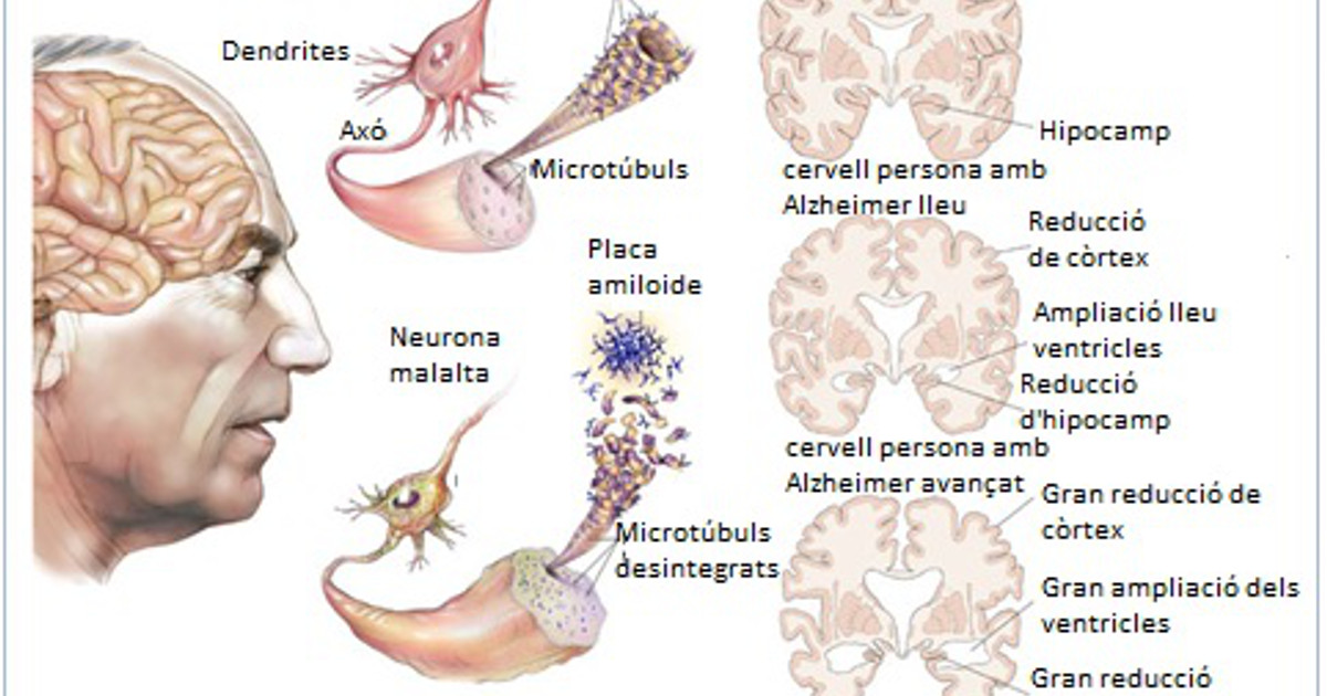 Alzheimer